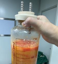 韩城水动力吸脂手术要做多久？